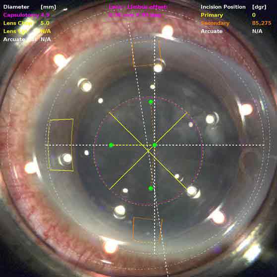 best cataract treatment Hospital in Pathanamthitta
