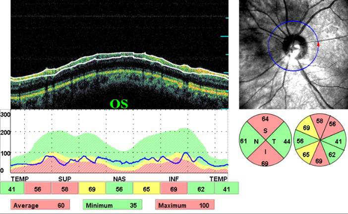 glaucoma surgery Kerala