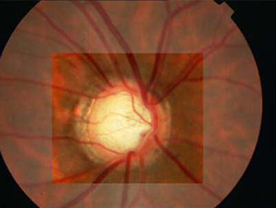 Advanced Glaucoma Treatment Options in Kerala